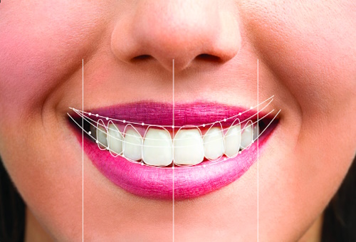 Smile Designing-in-Hyderabad