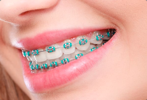 Orthodontic Braces-in-Hyderabad