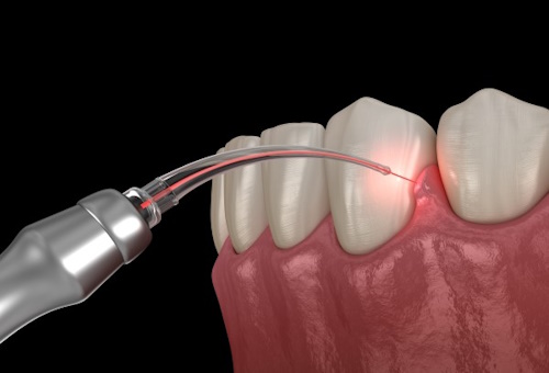 Laser Dentistry-in-Hyderabad