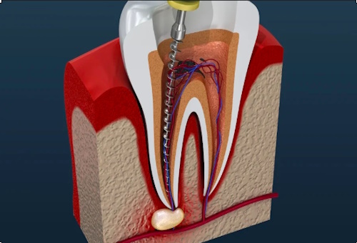 Root-canal-treatment-in-Hyderabad